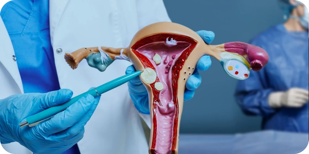 Cirurgia para Miomas
